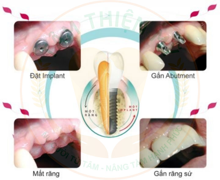 Răng implant lung lay - nguyên nhân - giải pháp khắc phục triệt 7 Phòng ngừa răng Implant bị lung lay