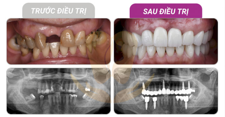 sự khác biệt trong quy trình trồng răng implant chuẩn y khoa