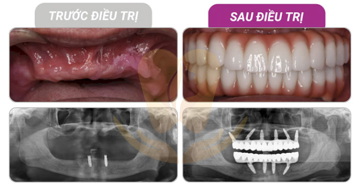 sự khác biệt trong quy trình trồng răng implant chuẩn y khoa