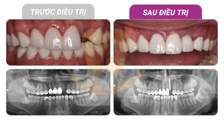sự khác biệt trong quy trình trồng răng implant chuẩn y khoa