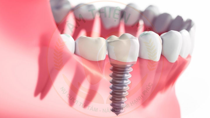 phương pháp Implant chịu lực tức thì
