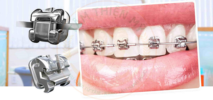 Niềng răng mắc cài kim loại tự động