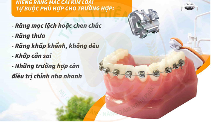 Niềng răng mắc cài kim loại tự động
