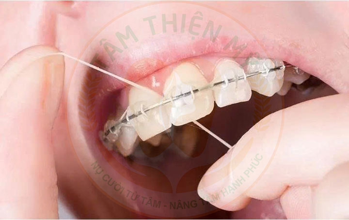 Những kinh nghiệm niềng răng mắc sứ cho các đồng niềng 4 kinh nghiệm niềng răng mắc sứ