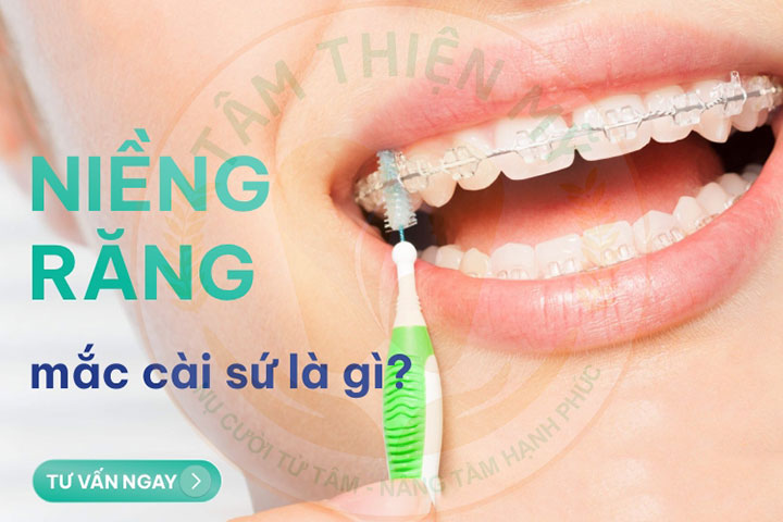 Những kinh nghiệm niềng răng mắc sứ cho các đồng niềng 5 kinh nghiệm niềng răng mắc sứ