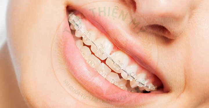 Mắc cài sứ tự buộc là gì? Ưu nhược điểm - chi phí? 6 niềng răng mắc cài sứ