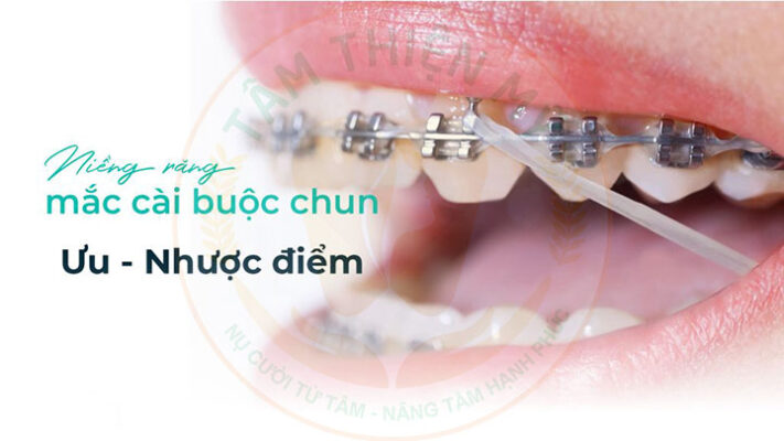 Uu nhuoc diem nieng rang mac cai buoc chun