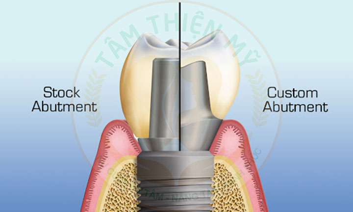 abutment cá nhân