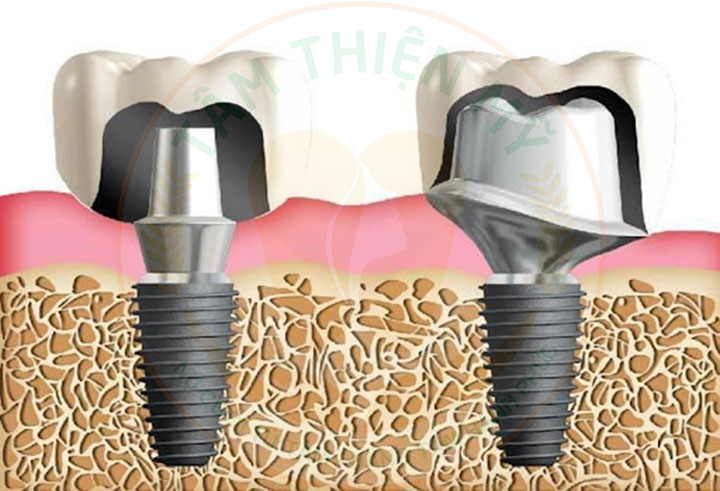 abutment cá nhân hóa