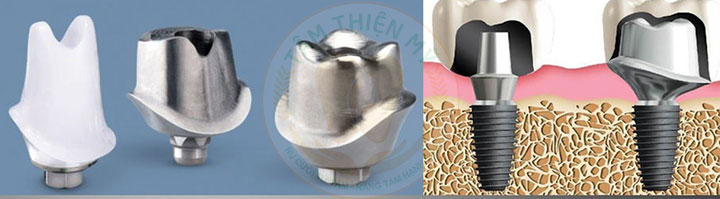 Abutment cá nhân hóa bằng Titan