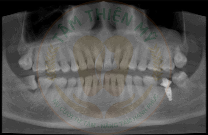 Quy trình phục hình răng trên Implant chuẩn nhất 2026 6 phim ct cone beam