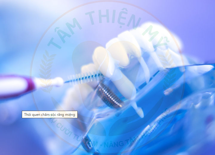 Hướng dẫn chế độ chăm sóc răng Implant được bền đẹp trọn đời 5 chăm sóc răng implant