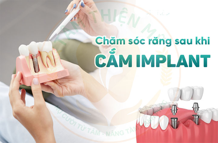 chăm sóc răng implant