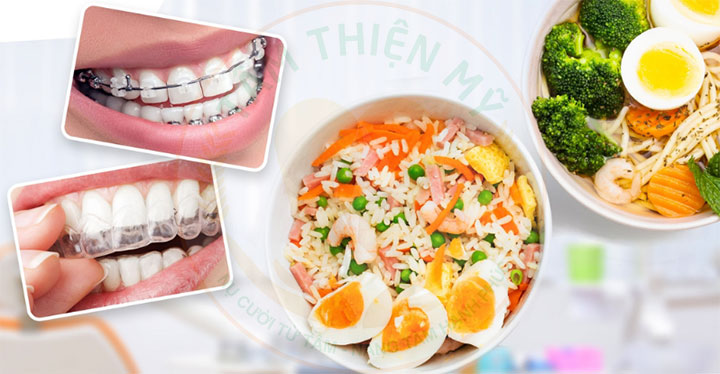 Những kinh nghiệm niềng răng mắc sứ cho các đồng niềng 7 kinh nghiệm niềng răng mắc cài sứ