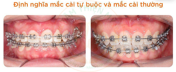 Nên chọn niềng răng mắc cài tự đóng và mắc cài thường? 2 niềng răng mắc cài tự đóng và mắc cài thường