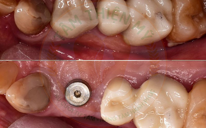 Healing Abutment
