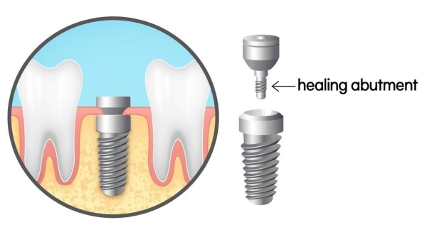 Healing Abutment