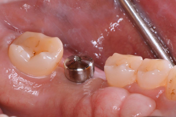 Healing Abutment