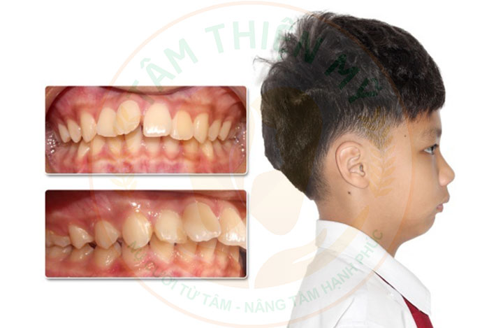 Đối tượng nào phù hợp niềng răng mắc cài kim loại? 6 răng vẩu nên niềng răng mắc cài kim loại