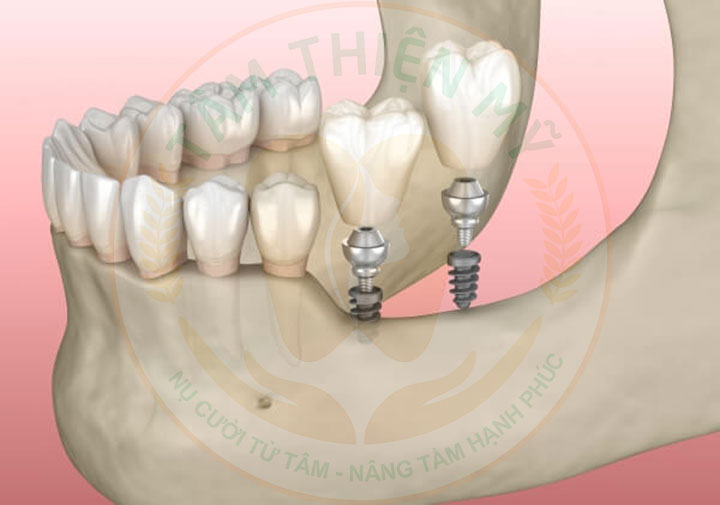 chi phí cấy mini implant