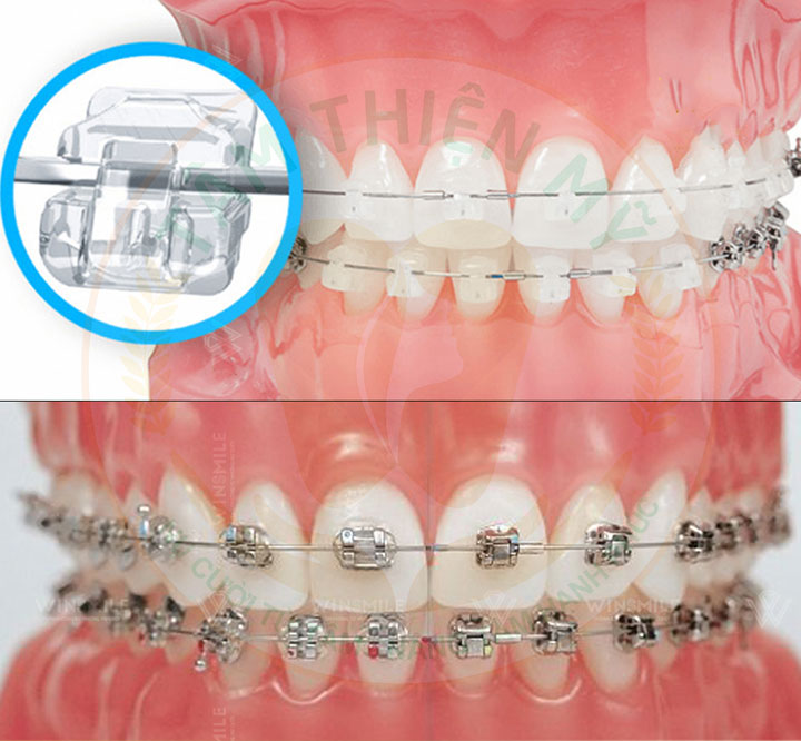 mắc cài 3m là gì