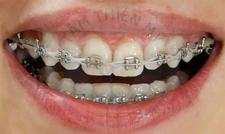 niềng răng mắc cài buộc chun