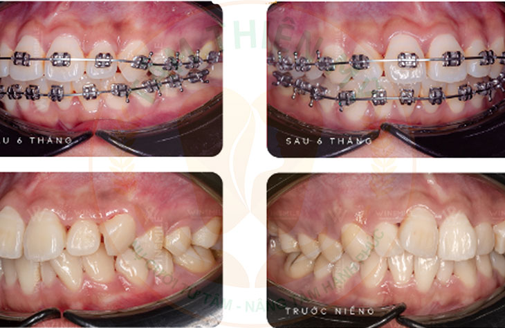 niềng răng mắc cài buộc chun