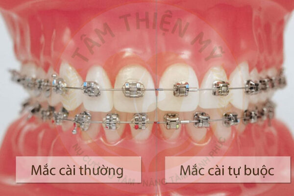 niềng răng mắc cài tự đóng và mắc cài thường