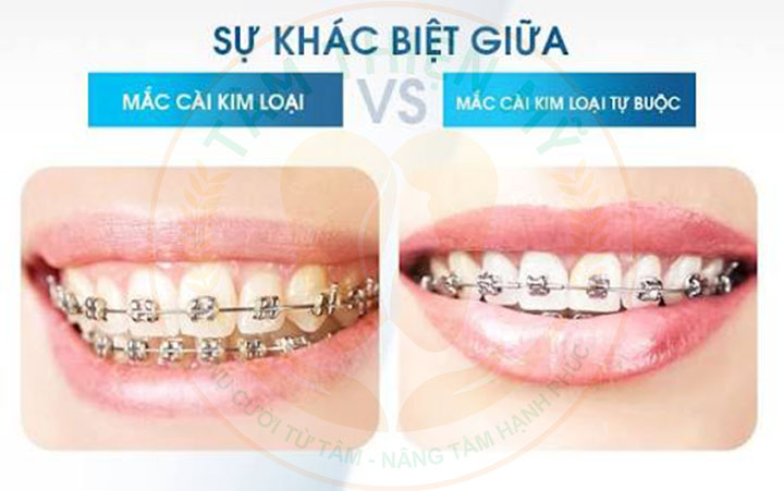 Nên chọn niềng răng mắc cài tự đóng và mắc cài thường? 4 niềng răng mắc cài tự đóng và mắc cài thường