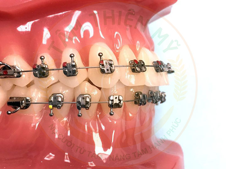 Niềng răng mắc cài tự động giá bao nhiêu? 7 niềng răng mắc cài tự động
