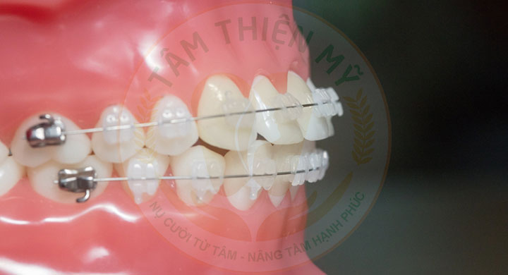 Niềng răng mắc cài sứ 3M