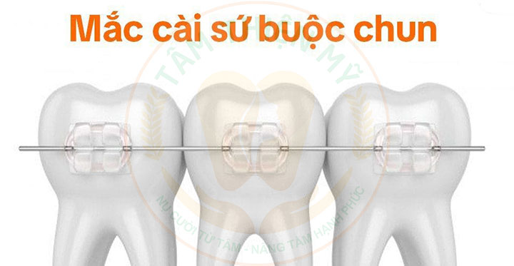 niềng răng mắc cài sứ thường