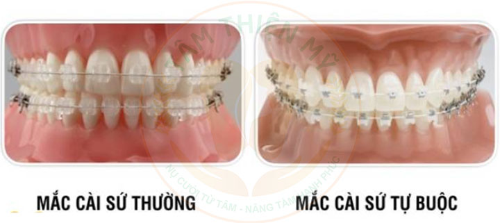 niềng răng mắc cài sứ thường hay mắc cài sứ tự buộc