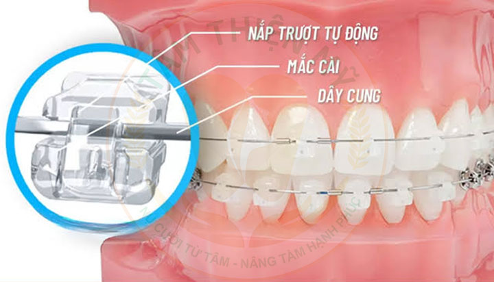 Mắc cài sứ tự buộc là gì? Ưu nhược điểm - chi phí? 3 mắc cài sứ tự động là gì