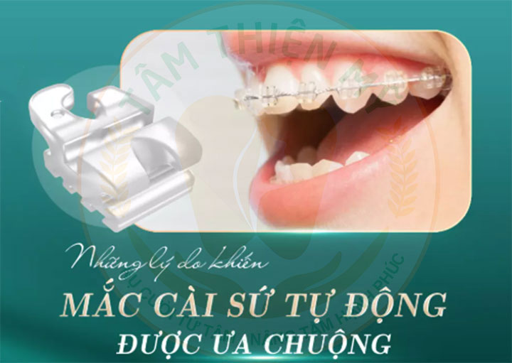 Niềng răng mắc cài tự động giá bao nhiêu? 4 Niềng răng mắc cài sứ tự buộc/ tự đóng