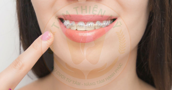 Mắc cài sứ tự buộc là gì? Ưu nhược điểm - chi phí? 4 mắc cài sứ tự động là gì