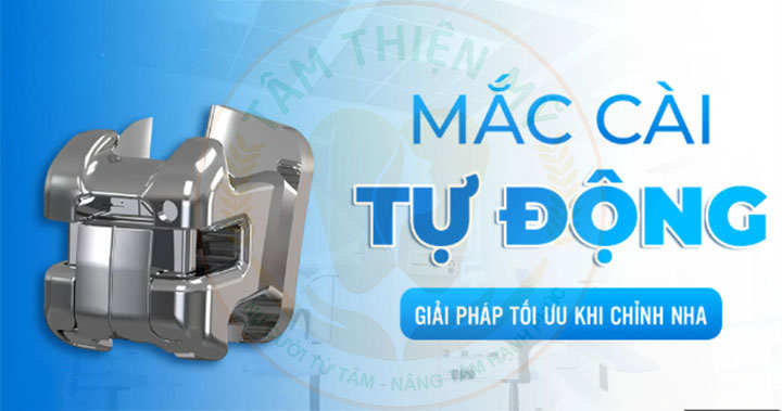 niềng răng mắc cài tự động