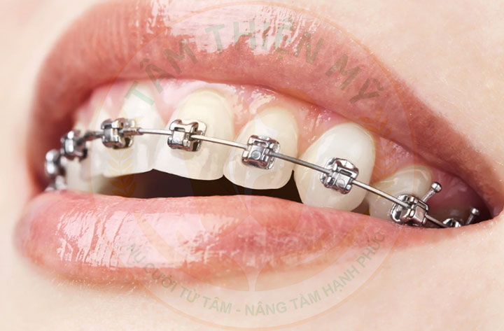 mắc cài kim loại tự đóng