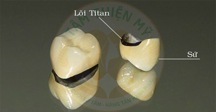 mão sứ titan