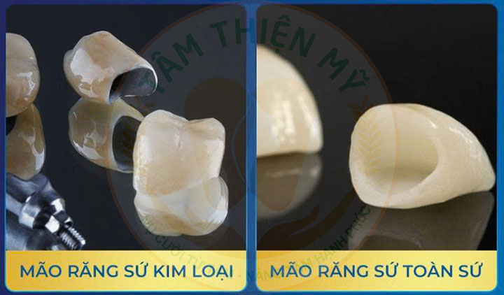 mão sứ răng Implant