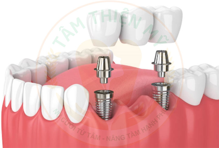 mão sứ răng Implant