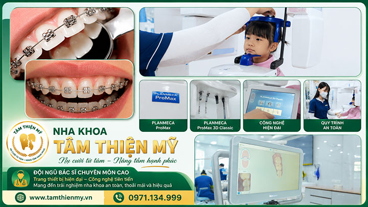 niềng mắc cài sứ thường