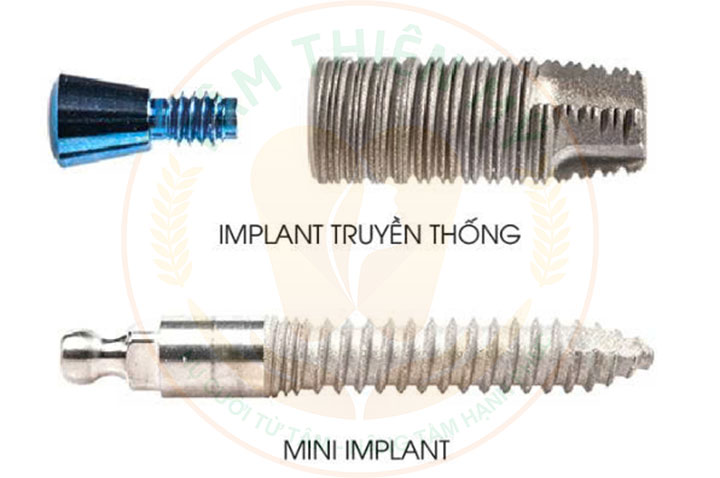 mini implant ưu điểm