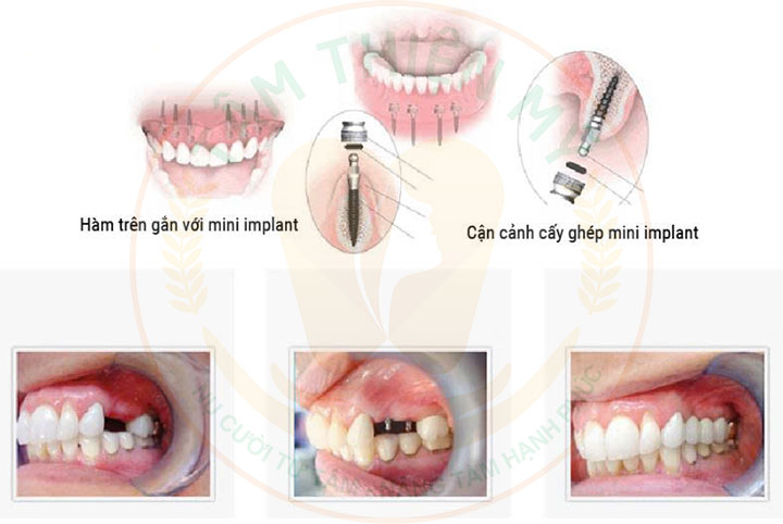 chi phí mini implant 