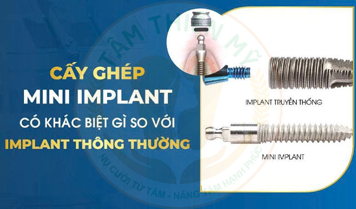 Cấy ghép mini Implant là gì