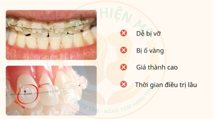 Niềng răng mắc cài sứ có đau không? Giá bao nhiêu? 6 nhược điểm mắc cài sứ
