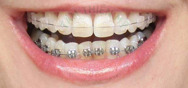 Bác sĩ chỉnh nha giải đáp - Nên niềng mắc cài sứ hay kim loại? 3 Nên niềng răng mắc cài sứ hay kim loại