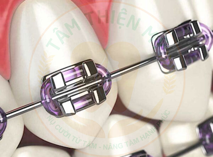 niềng răng mắc cài 3M