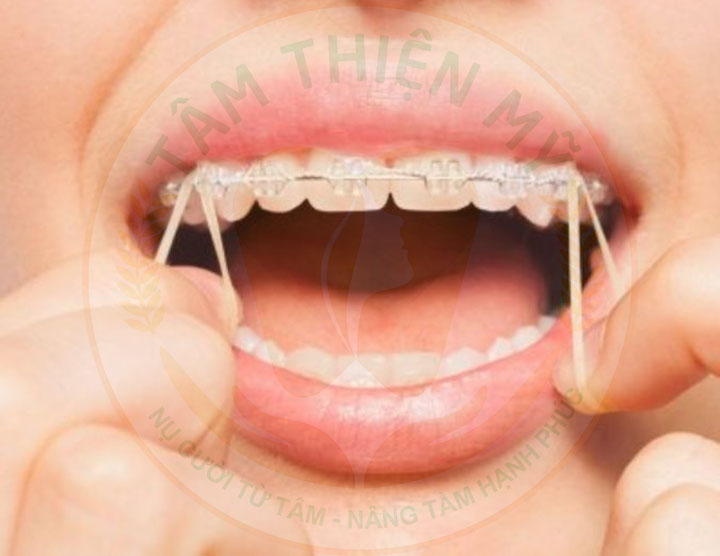 niềng mắc cài sứ thường