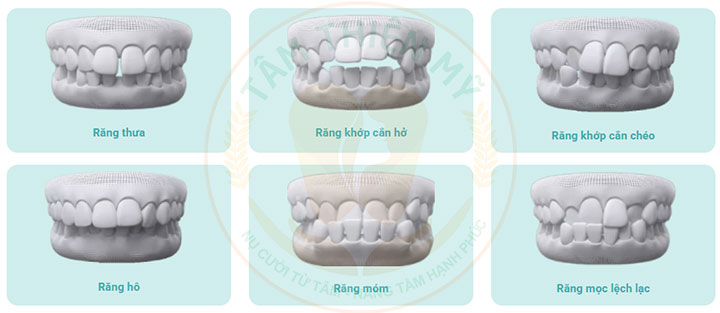 Niềng răng mắc cài kim loại thường giá bao nhiêu? 5 niềng răng mắc cài kim loại